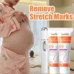 Remove Stretch Marks Laser Pen Treatment For Abdomen Stretch Marks Moisturize Hydrating Anti Wrinkle For Abdominal In Pregnancy